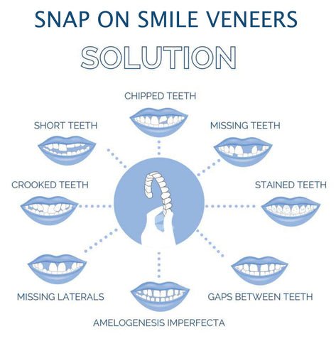 Dental Impression Smile Veneer Set for Men & Women - Lexians