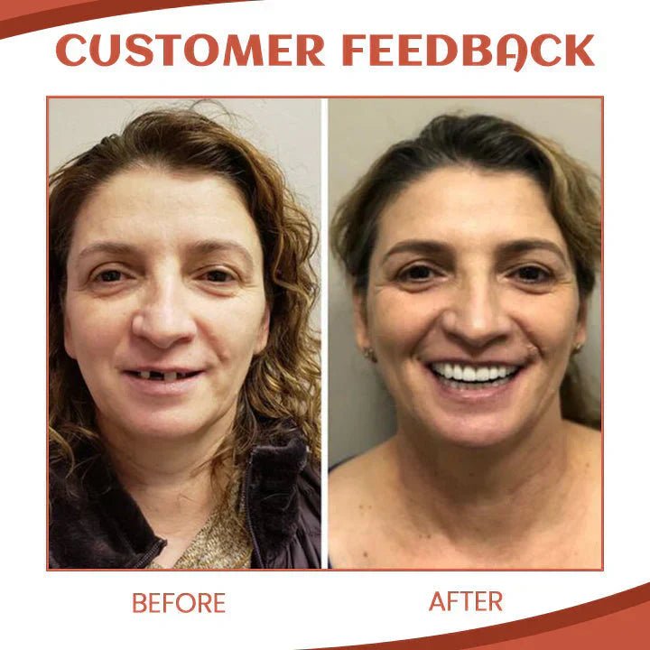 Adjustable Silicone Denture Set for a Natural Smile - Lexians