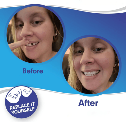 Dental Impression Smile Veneer Set for Men & Women - Lexians
